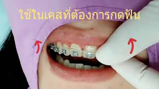 ยิ้มเห็นเหงือกแก้ได้ไหม มาลองดู เคสนี้กัน