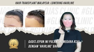 Hair Transplant in Malaysia | Pakar Tanam Rambut Malaysia | Menurunkan Garis Rambut