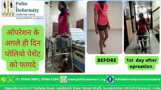 ऑपरेशन के अगले ही दिन पोलियो #( Polio ) पेशेंट को फायदे #Bholahospital #Poliotreatment# Ilizarov