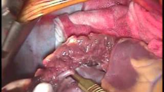 Partial Left Ventriculectomy (Batista operation) for severe dilated cardiomyopathy