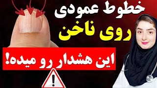 چه چیزی باعث خطوط  عمودی روی ناخن ها میشه؟!