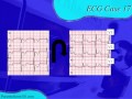 paramedicine101 ecg case 17