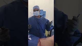 Dr. Ravi on Creating the Perfect Belly Button During a Tummy Tuck