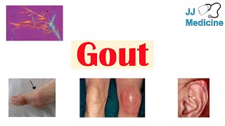 Gout | Causes, Pathophysiology, Risk Factors (ex. Diet), Symptoms, Diagnosis, Treatment