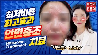 (*ENG/CHN/JP) 안면홍조, 레이저 없이 치료하기 rosacea, facial flushing treament - 피부과전문의 [닥터필러]