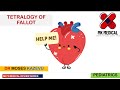 Tetralogy of Fallot (TOF)