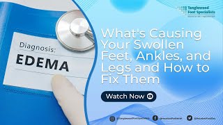 What's Causing Your Swollen Feet, Ankles, and Legs and How to Fix Them