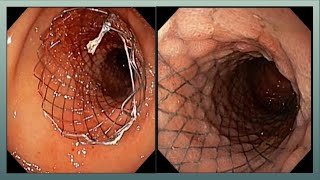 Duodenal Stenting l Gastric Outlet Obstruction l Metal stent l ডিওডেনাল স্টেন্টিং #BD_ENDOSCOPY