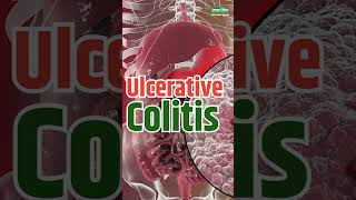 खून बहना हुआ बंद। HIIMS में आकर मिला Ulcerative Colitis में आराम। Patient Review at HIIMS |Manish ji