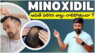 #AskDrJohnWatts | MINOXIDIL ఆపితే పెరిగిన జుట్టు రాలిపోతుందా ? | Hair Specialist Explains