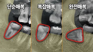 매복정도에 따른 매복치 발치 사례 (단순매복,복잡매복,완전매복)