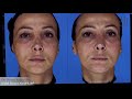 dr. hervé raspaldo eiffel tower nose lift video freedly