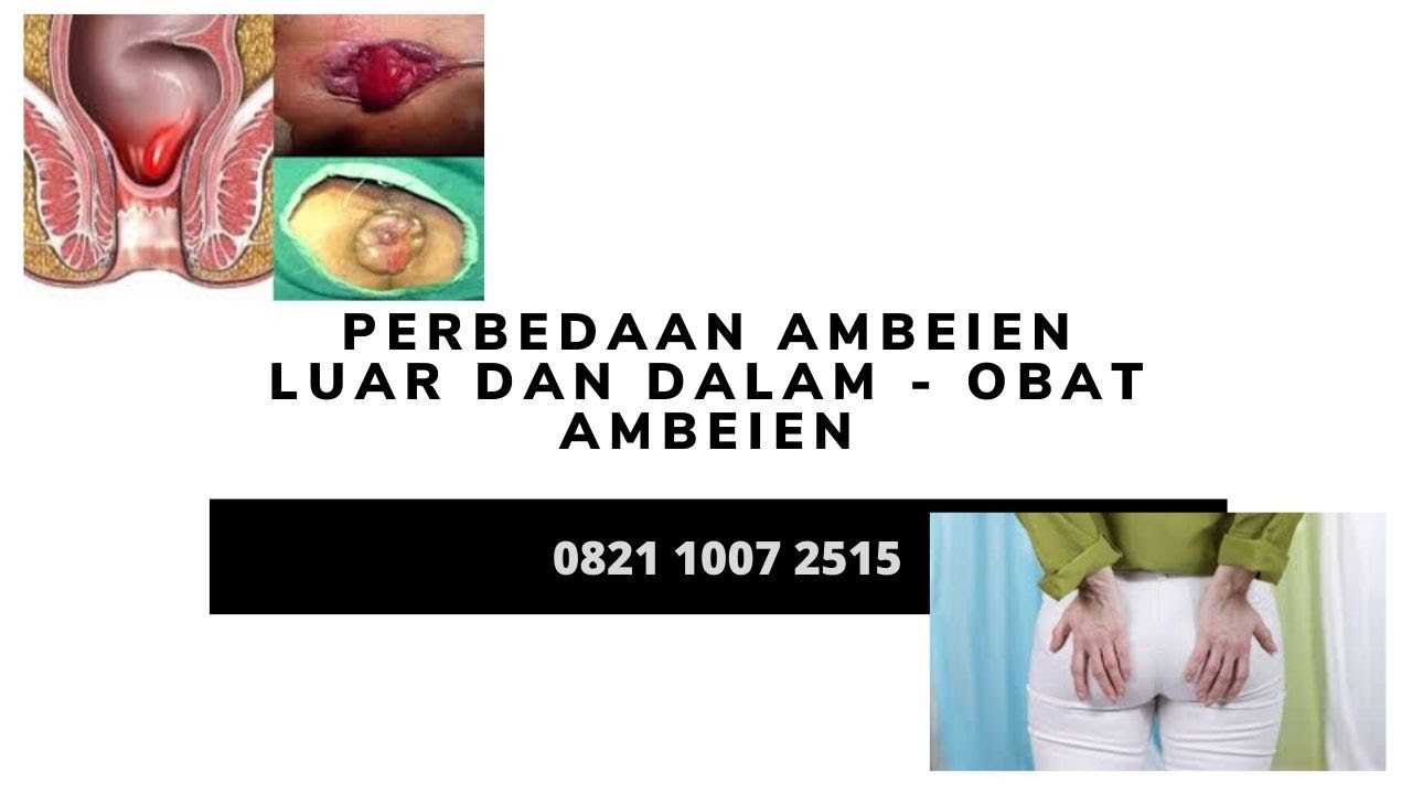 Perbedaan Ambeien Luar Dan Dalam - Obat Ambeien - YouTube