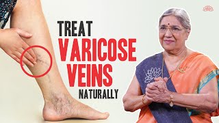 Natural Cure for Varicose Veins | Home Remedies to Treat Varicose Veins | Dr. Hansaji Yogendra