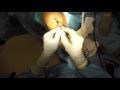 Fresh osteochondral allograft plug technique