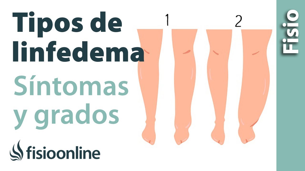 Congreso Vascular Ecuador Cela 2018 Las Causas De Linfedema 53 Off