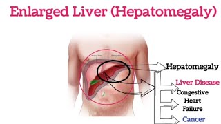 Enlarged Liver or Hepatomegaly || Signs and Symptoms|| Causes || Risk Factors || Treatment