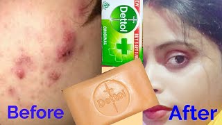 इसको लगा लेने से पिम्पल्स जड़ से खत्म #Pimples #Pimple #Dettolsoap #Dettol #DIY #Pimplesremedies