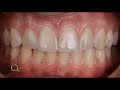 multiple diastema closure with composite resin