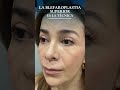 Transforma tu Mirada con Blefaroplastia Superior