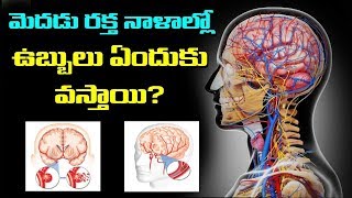 మెదడు రక్త నాళాల్లో ఉబ్బులు ఎందుకు వస్తాయి | Cerebral Aneurysm | Health Tips