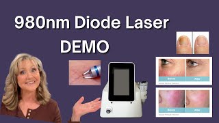 980nm Diode Laser DEMO | ZAP SPIDER VEINS!!! |TOE NAIL FUNGUS GONE!!!