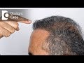 How does hair transplantation work? - Dr. Madan Kumar BJ