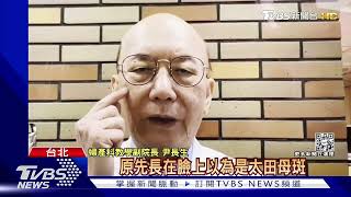 黃子佼爆「孟耿如為孩蒙古斑」哭整晚 醫:慢慢退｜TVBS新聞