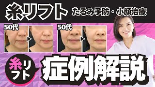 【糸リフト症例解説】30代〜50代女性の糸リフトはどの糸を何本入れている！？口横ぽにょが劇的に変わる！★糸リフトでたるみ予防★若返り治療