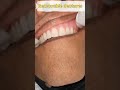 shorts ഊരിയെടുക്കാൻ കഴിയുന്ന വെപ്പുപല്ലുകൾ removable dentures