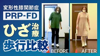 【変形性膝関節症の歩行症例】PRP-FD注射を受けた患者様の治療経過