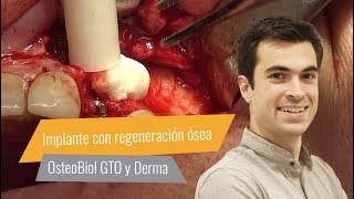 Colocación de implante con regeneración ósea - Dr. Arturo Flores