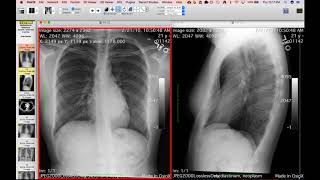 STR Cardiothoracic Case Webinar 2/8/2018