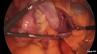 Ileocolic Intussusception-Laparoscopic Right Hemicolectomy