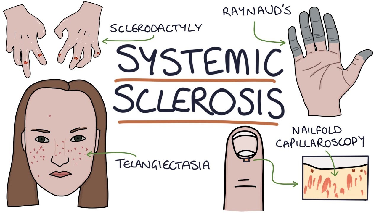 Systemic Sclerosis And Scleroderma: Visual Explanation For Students ...