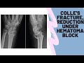 Distal radius colles' fracture reduction and plaster application under haematoma block ortho vid 6