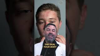 How do acne scars form?