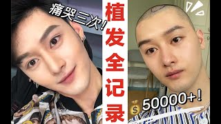 哭了三次的植发Vlog？！竟还被喷子攻击！|秃头男孩的植发全记录