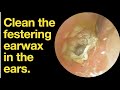 Clean the festering earwax in the ears. |ear wax removal | ear cleaning | ASMR | relaxation | relax