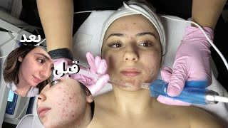 MICRONEEDLING 😲 العلاج الذي أنقذ بشرتي