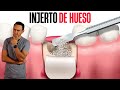 ¡No te pongas injerto de hueso sin ver este video!