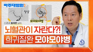 그냥 두통? 모야모야병의 두통? 모야모야병의 전조증상은 ‘OOO두통’🧠 원리, 증상, 치료법까지 핵심정리해 드립니다!! 신경과 홍지만 교수 [아주대병원TV]