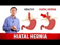 Quick Fix For Hiatal Hernia – Dr. Berg