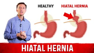 Quick Fix For Hiatal Hernia Dr Berg