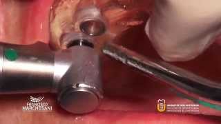 GUIDED SURGERY AT THE UPPER JAW WITH BIOHORIZONS IMPLANTS