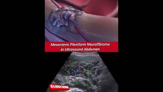 Mesenteric Plexiform Neurofibroma # Ultrasound Scan # Radiology