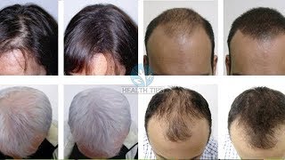 ये हैं वो इकलौती चीज जो गंजे सिर पर फिर से उगा सकती है बाल 100% Effective Hair Regrowth Remedy