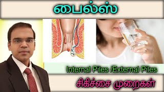 மூலநோய்க்கு  தீர்வு  Piles Treatment மூல நோயை குணபடுத்துவது எப்படி? hemorroid