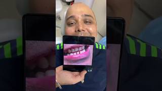 How easy is to close the gaps between teeth | Dontia Dental Care Kolkata #teeth #youtube #ytshorts