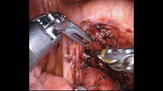 Asvide: Robotic resection of a complex middle mediastinal mass of  4.5 cm in diameter